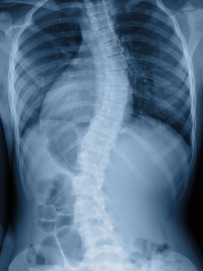 xray of spine with curve
