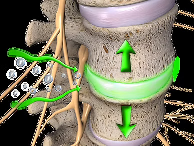 Anatomical illustration of two spinal vertebrae, an intervertebral disc, and nerves. Green arrows indicate disc expansion, and bubbles flow along green paths towards the nerves.