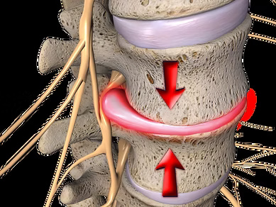 3D illustration of a herniated spinal disc compressing a nerve root between two vertebrae, with red arrows indicating compression.