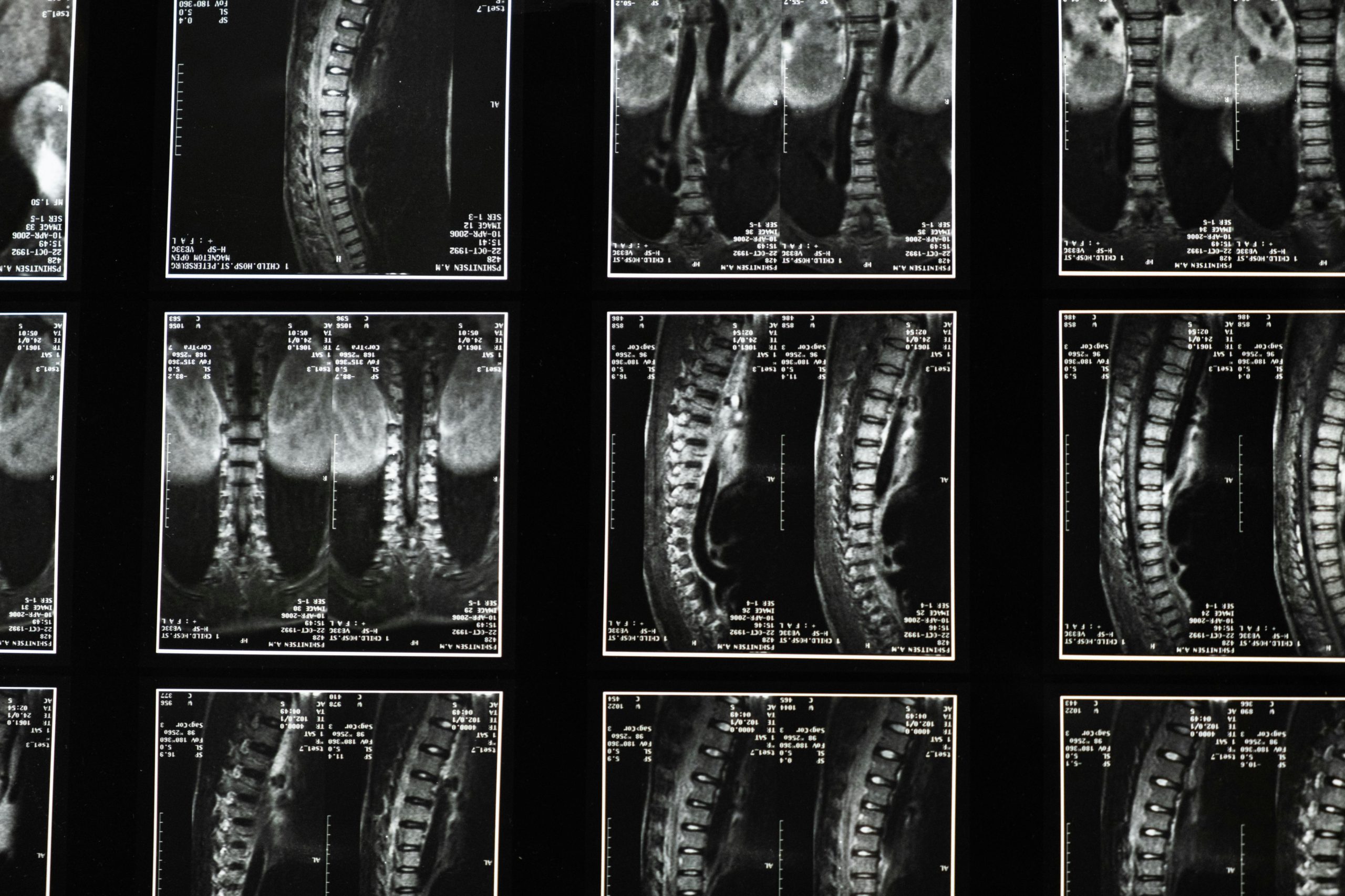 A grid of twelve black and white MRI scans of a human spine, with medical text overlays.
